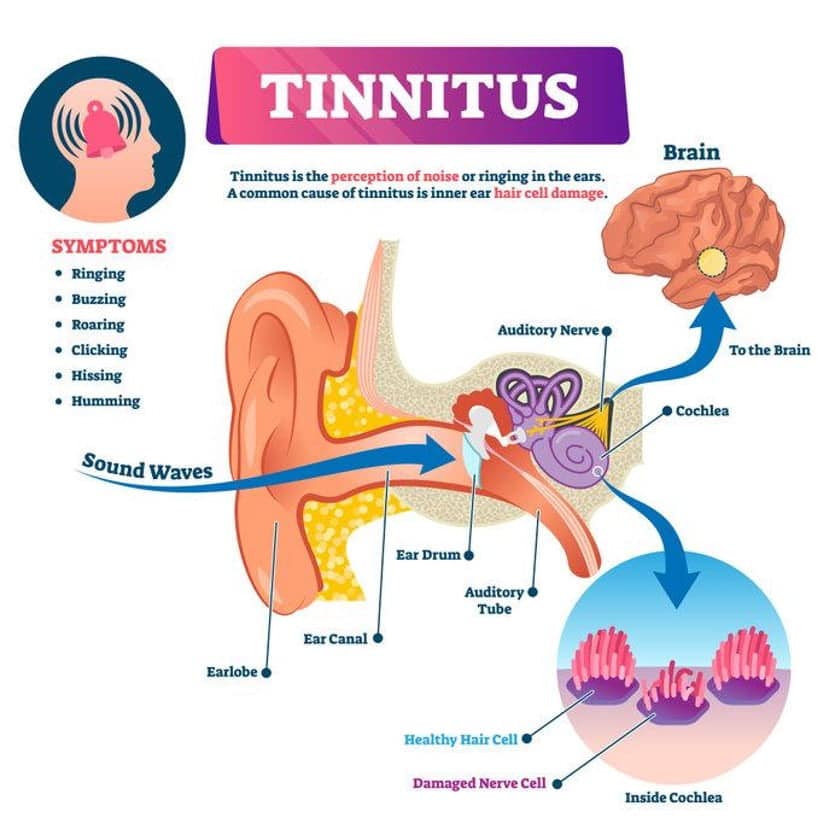: Tinnitus vector illustration explaining symptoms with cochlea closeup.